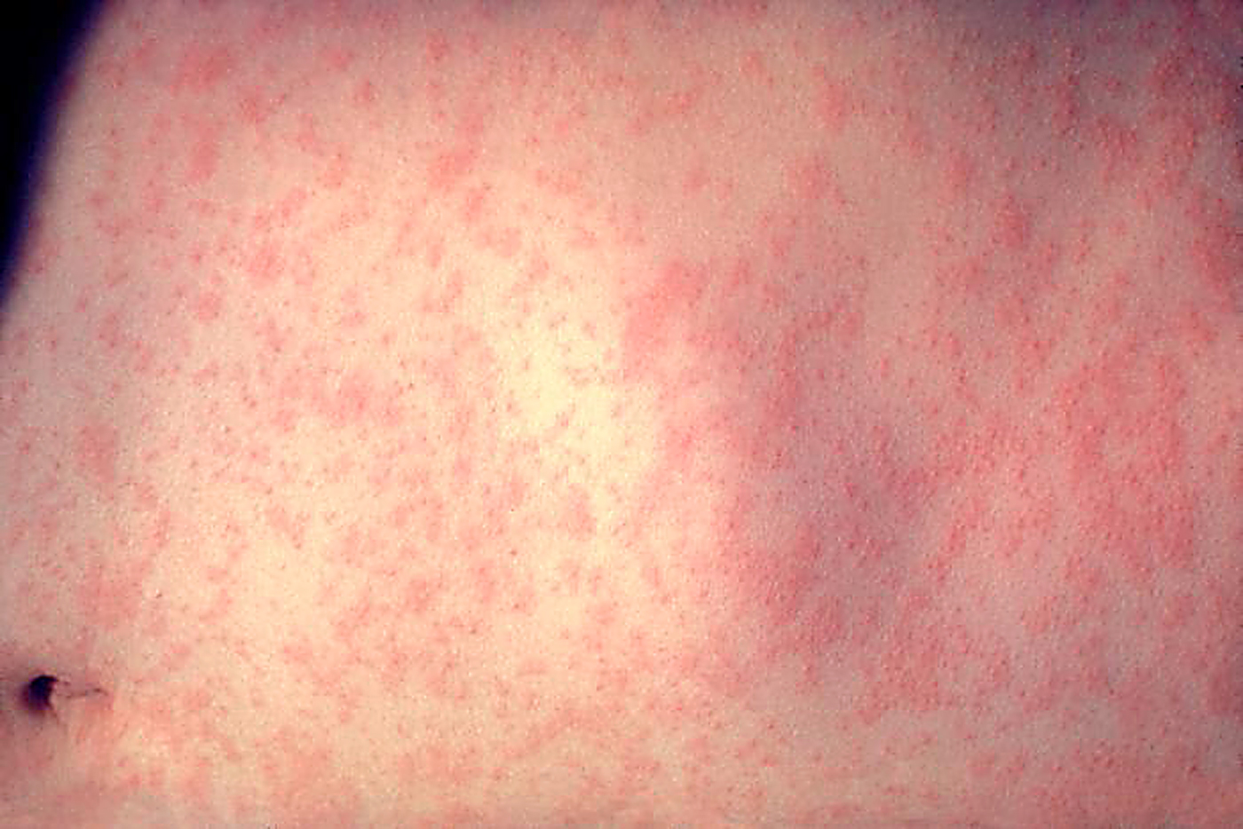 AA Measles1