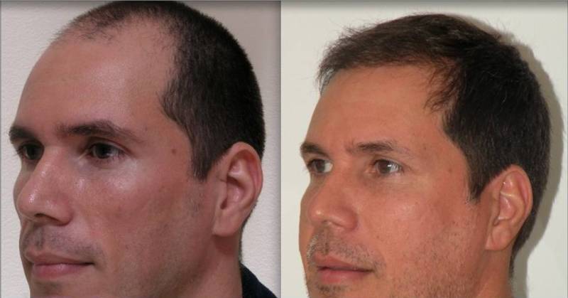 This photo shows a patient before and after undergoing the NeoGraft hair restoration procedure. (Submitted photo) 