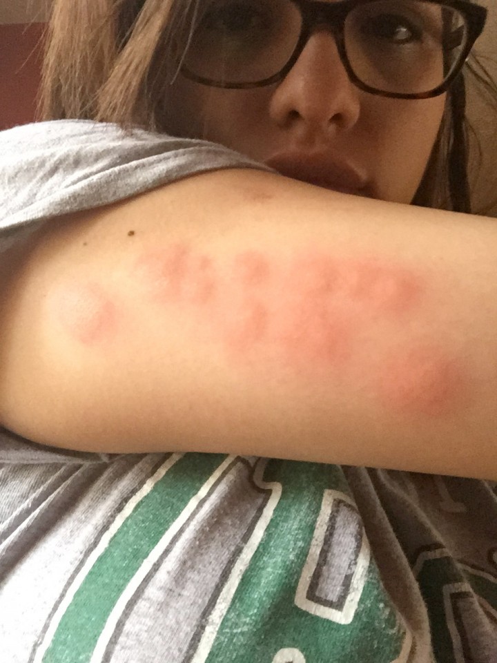 Brisa Acuna says a trip to the AMC Showplace at Traders Point led to bedbug bites and a trip to the doctor. (Submitted photo)